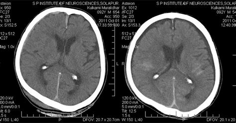 Neuroradiology Cases: Post traumatic Subdural Hygroma