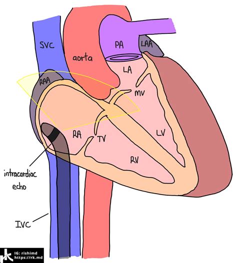 Intracardiac Echocardiography (ICE) | RK.MD