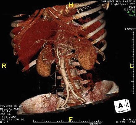 Surgical Anatomy of the Retroperitoneum | Abdominal Key