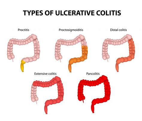 Ulcerative Colitis Doctors - Piedmont Colorectal Specialists