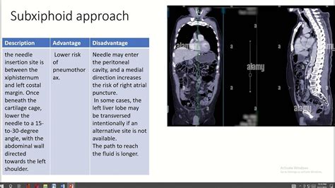 Anatomy of pericardiocentesis - YouTube