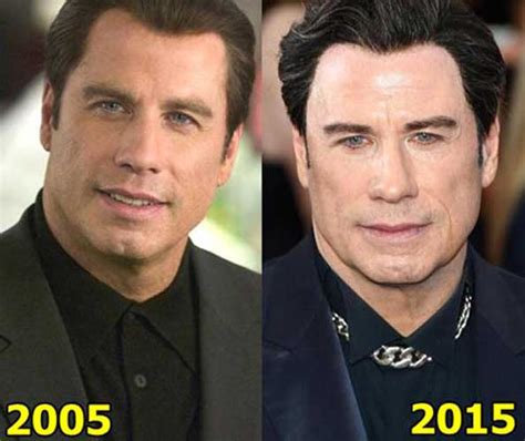 John Travolta Plastic Surgery: Facelift, Botox, Hair transplant