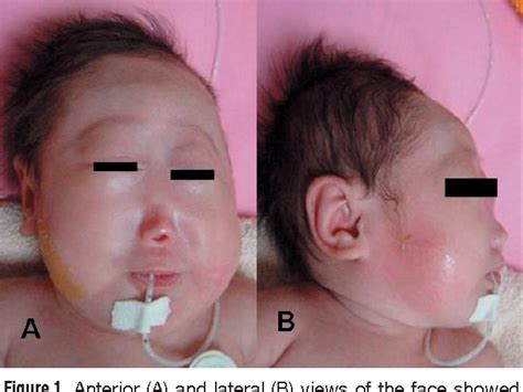 Holoprosencephaly (HPE): What It Is, Causes Types, 43% OFF