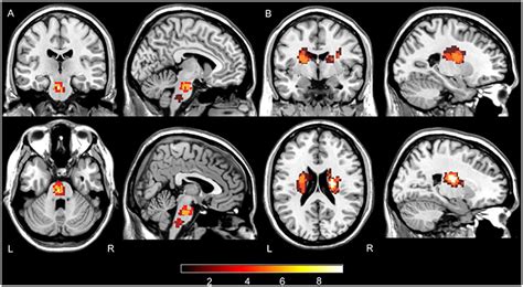 Corona Radiata Infarct Treatment / Wallerian degeneration, infarct and état criblé in a 62 ...