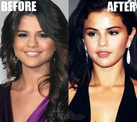 Selena Gomez Plastic Surgery Revealed! Before and After