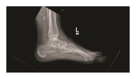 Final radiographs demonstrating development of talonavicular arthritis ...