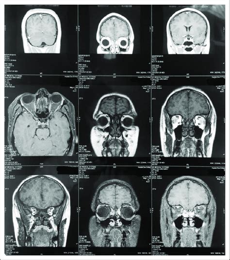 Orbital MRI revealing no abnormalities 9 months after diagnosis ...