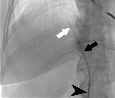 Percutaneous and Transvenous Liver Biopsy | Applied Radiology