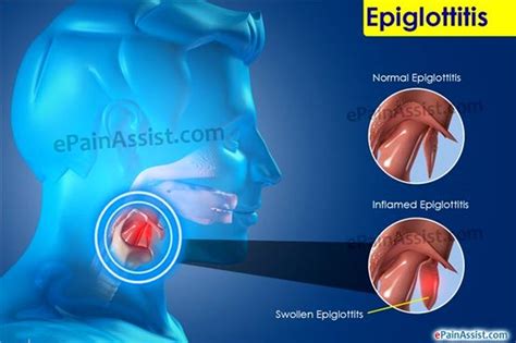 💊 Epiglotitis: Causas, síntomas, y Diagnóstico - 2020