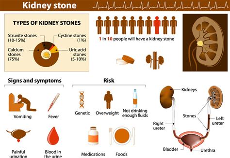 Kidney Stones - Associated Urological Specialists