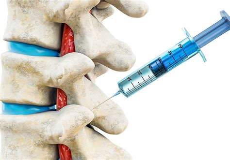 Facet Joint Injection And Medial Branch Blocks - OPMSM