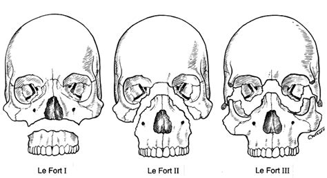 Braces, Jaws, and Joints. : Le Fort 1 Surgery