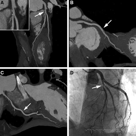 Coronary Angiography