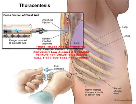 Thoracentesis Needle Size