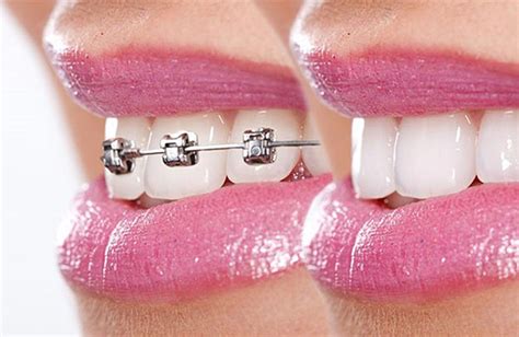 Aligned teeth with orthodontics - Dr Jamilian