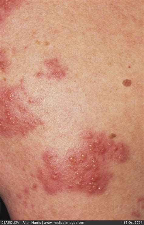 STOCK IMAGE, close-up of shingles herpes zoster showing small blistersin patches on the skin the ...