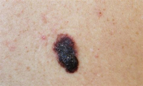 FDA Approves 1st T-Cell Therapy for Melanoma | The Epoch Times