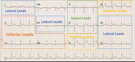 ECG Interpretation