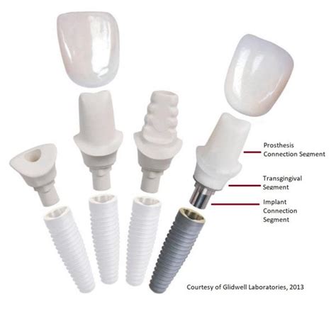 The Basics of Implant Abutments - Australasian Restorative and Implant Academy