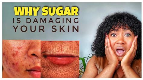 HOW EATING EXCESS SUGAR AFFECTS YOUR SKIN|SIDE EFFECTS OF SUGAR - YouTube