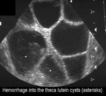 Ultrasound of Complete Molar Pregnancy