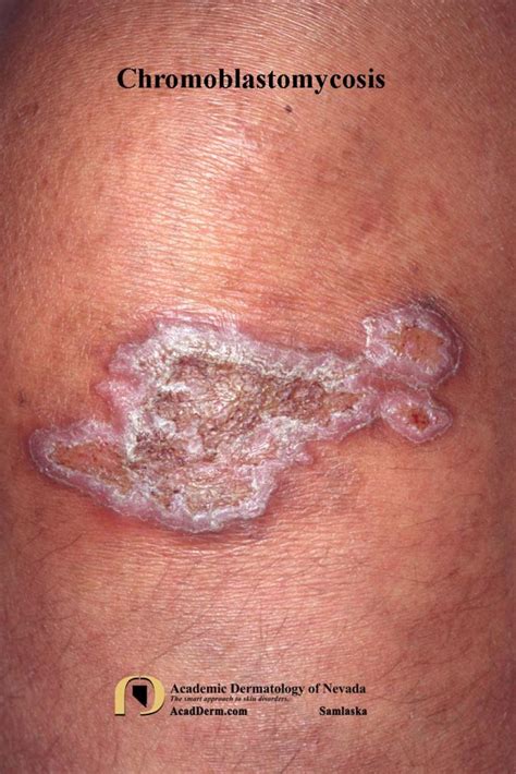 Chromoblastomycosis (CBM): Chromomycosis... - Academic Dermatology of Nevada