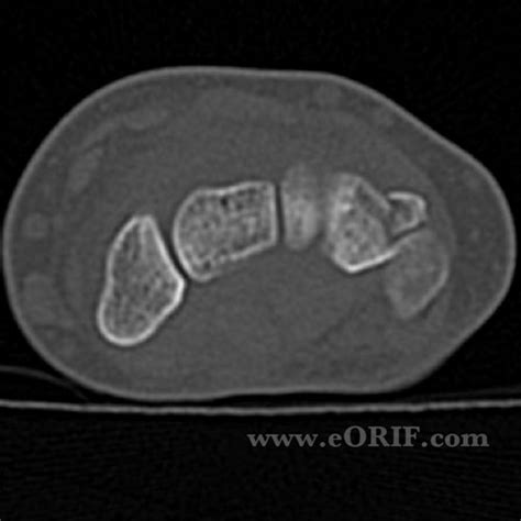 Triquetral Fracture S62.113A 814.03 | eORIF