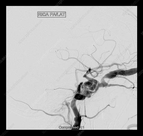 Carotid Cavernous Sinus Fistula - Stock Image - C043/5596 - Science Photo Library