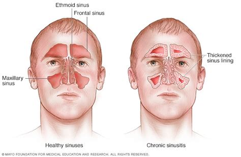 Chronic sinusitis - Symptoms and causes - Mayo Clinic