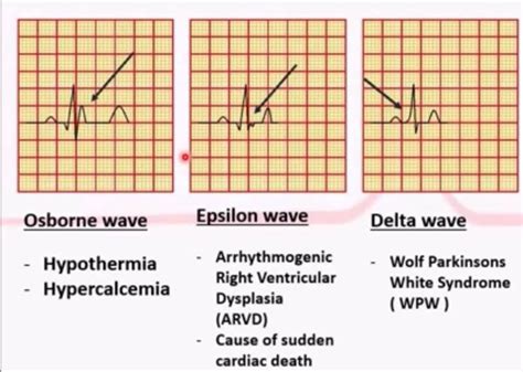 Osborne wave, epsilon wave, and delta wave and what they mean. #paramedic #nursing #cardiology ...