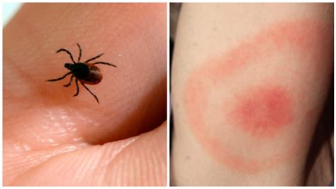 Ticks top of mind as risk of Lyme disease intensifies - Ottawa - CBC News