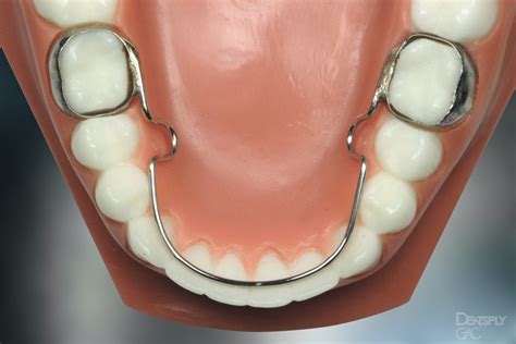 Shows a lingual arch on a model of teeth. | Teeth braces cost, Teeth ...