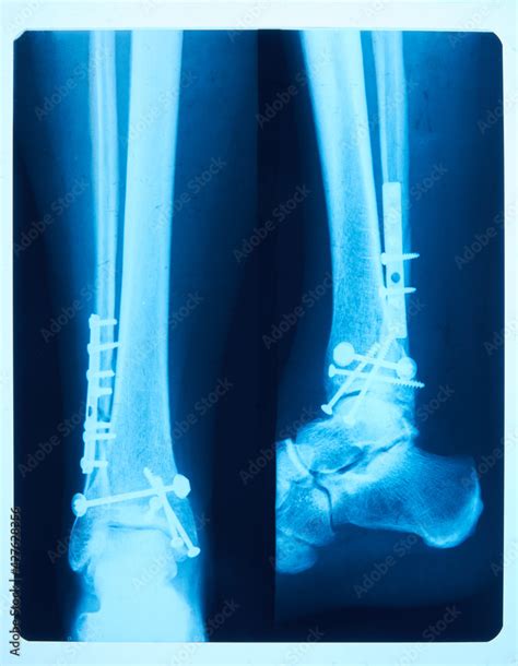 Image of film x-ray of human feet fracture front and side views, taken ...