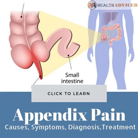 Where Is Your Appendix Located Female Diagram