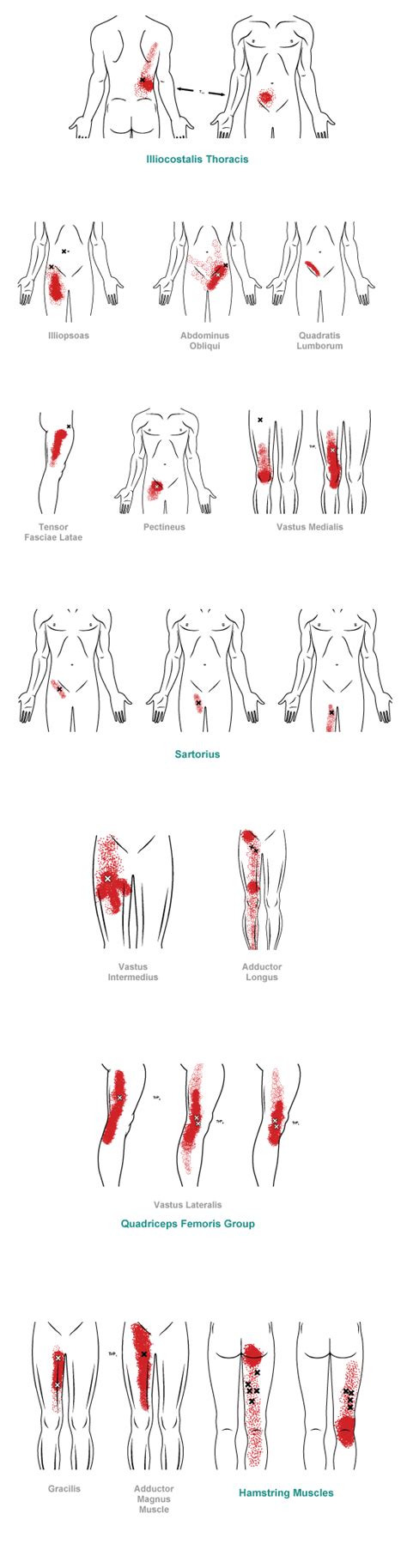 Groin & Thigh - Myofascial Pain Syndrome (muscle pain)