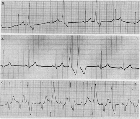 Case 8. (a) Ventricular bigeminy. (b) Closely coupled ventricular ...