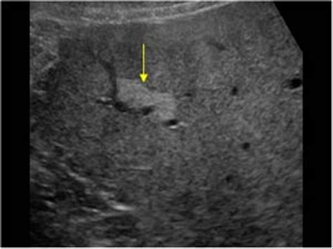 Abdomen and retroperitoneum | 1.1 Liver : Case 1.1.11 Fatty liver and ...