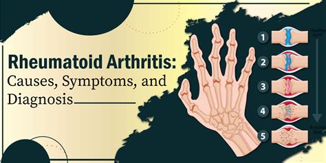 Rheumatoid Arthritis: Causes, Symptoms And Diagnosis