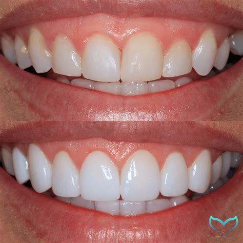 Composite VS Porcelain Veneers – You Need Everything