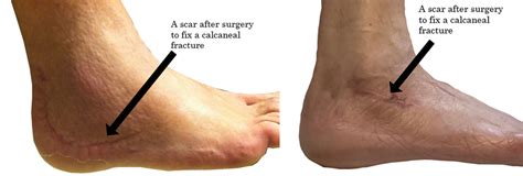 Calcaneus Fracture Swelling