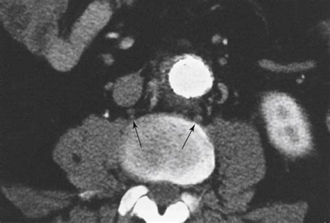 Lumbar Sympathectomy for Lower Extremity Ischemic Ulcers | Thoracic Key