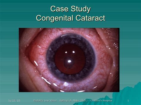 Case Study: Congenital Cataracts