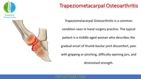 Trapeziometacarpal Osteoarthritis | OrthoFixar 2024