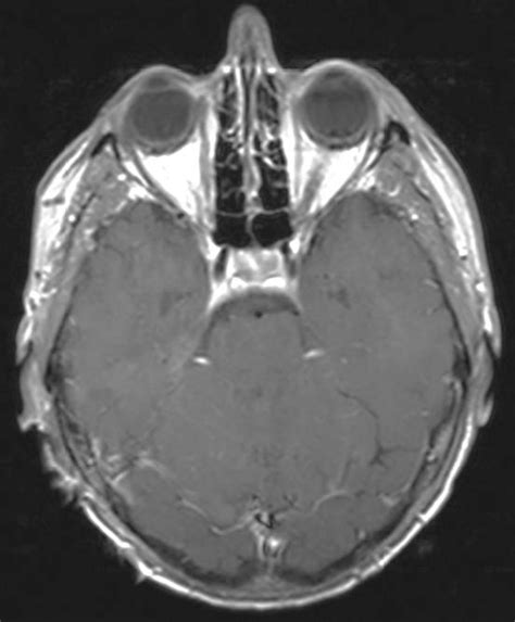 Right petroclival meningioma in a 58-year-old male with tinnitus. The... | Download Scientific ...