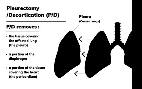 Pleurectomy/Decortication (P/D) | Surgery For Mesothelioma