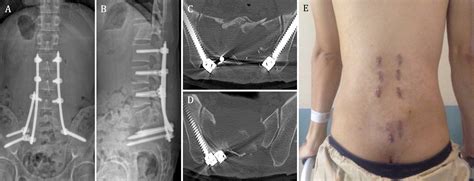 Minimally invasive dual iliac screw, dual rod fixation in a rare case ...