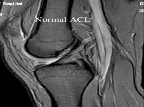 Mri Knee Acl Tear