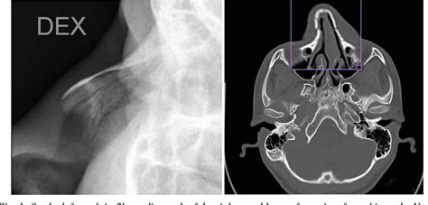 Nasal Fracture X Ray