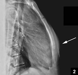 Acute Traumatic Sternum Fracture in a Female College Hockey Player