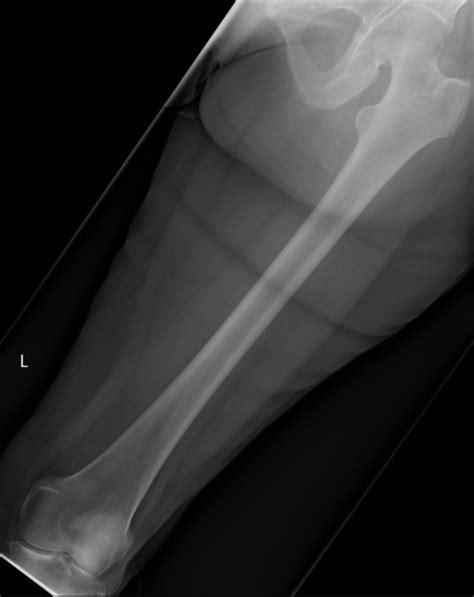 AP femur xray | X ray, Natural landmarks, Med school